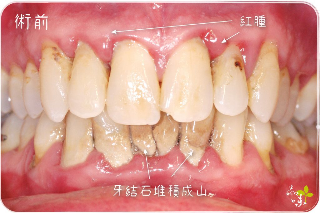 牙周病症狀