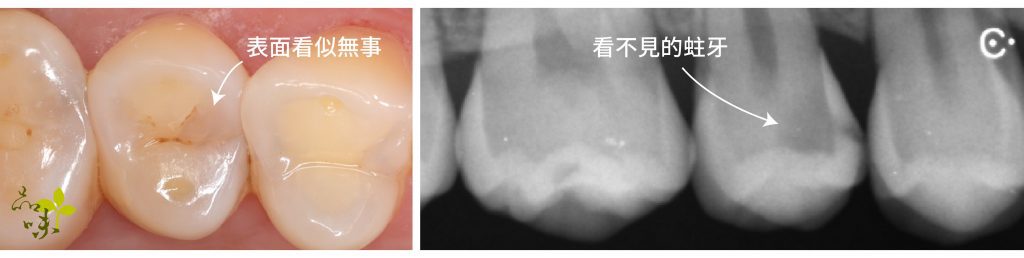 caries X-ray