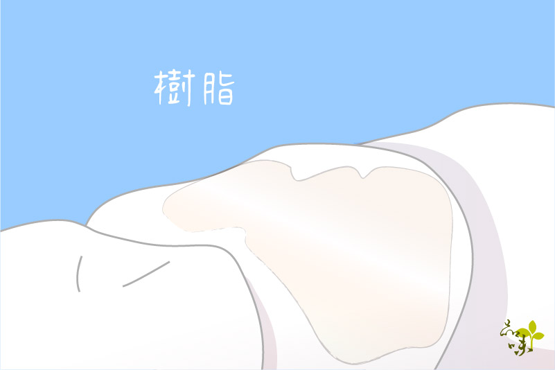 樹脂-最常見的補牙方式