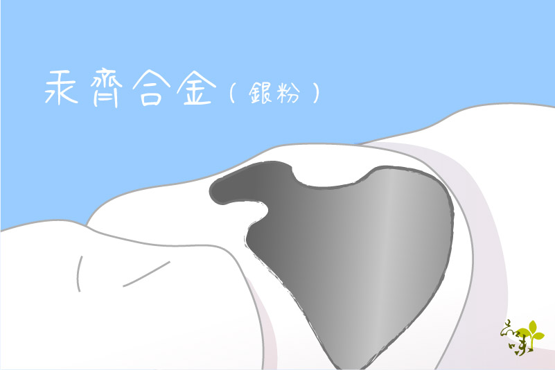 汞齊合金(銀粉)-古早時候的補牙材料