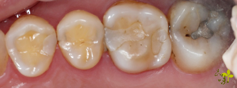 微創齒雕術前照片：病人牙齒鄰接面有多顆蛀牙，合併有齒裂細紋