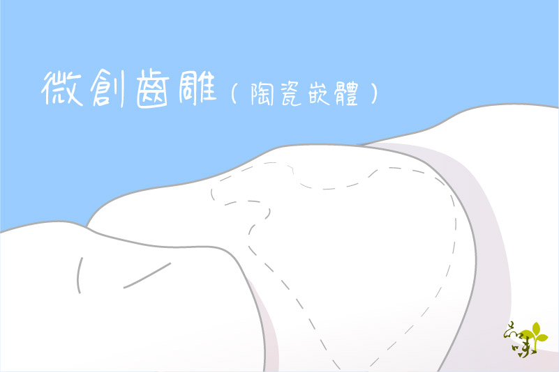 微創齒雕(陶瓷嵌體 / 3D齒雕)-新的補牙選擇