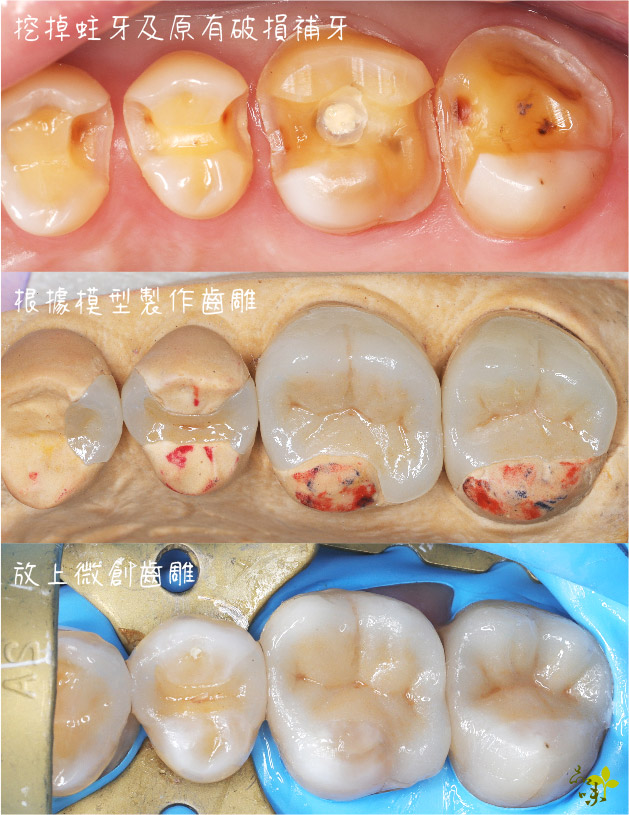 微創齒雕術照片：挖掉蛀牙、並製作模型