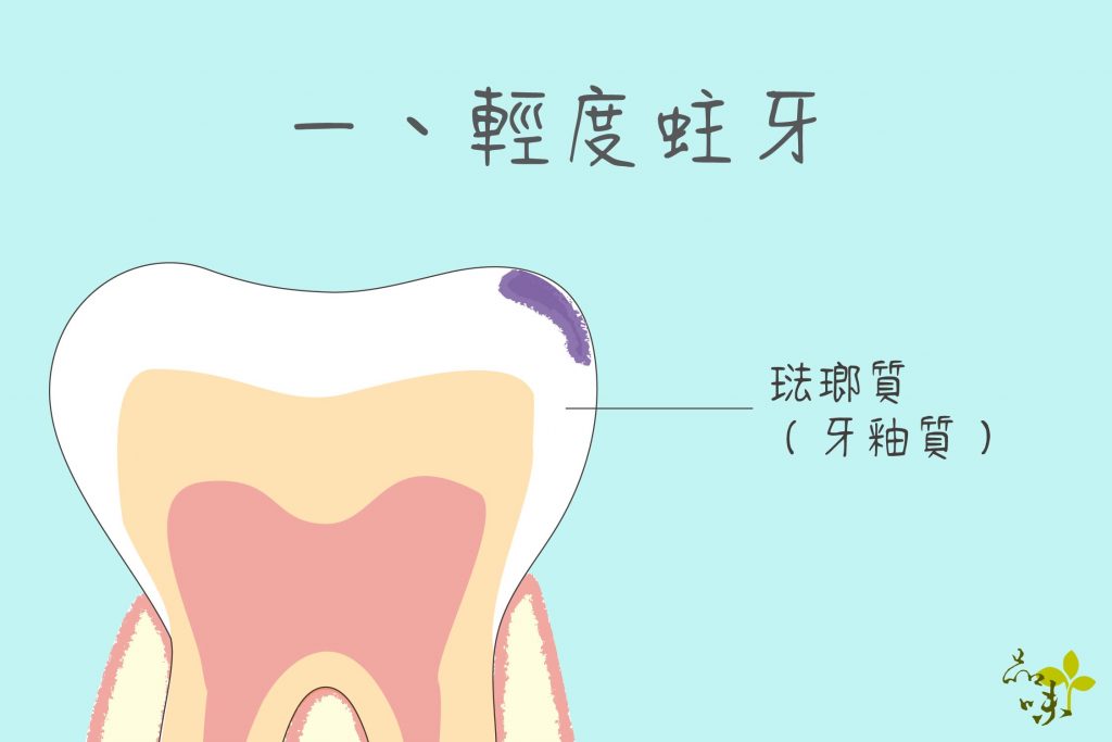 輕度蛀牙範圍只在琺瑯質