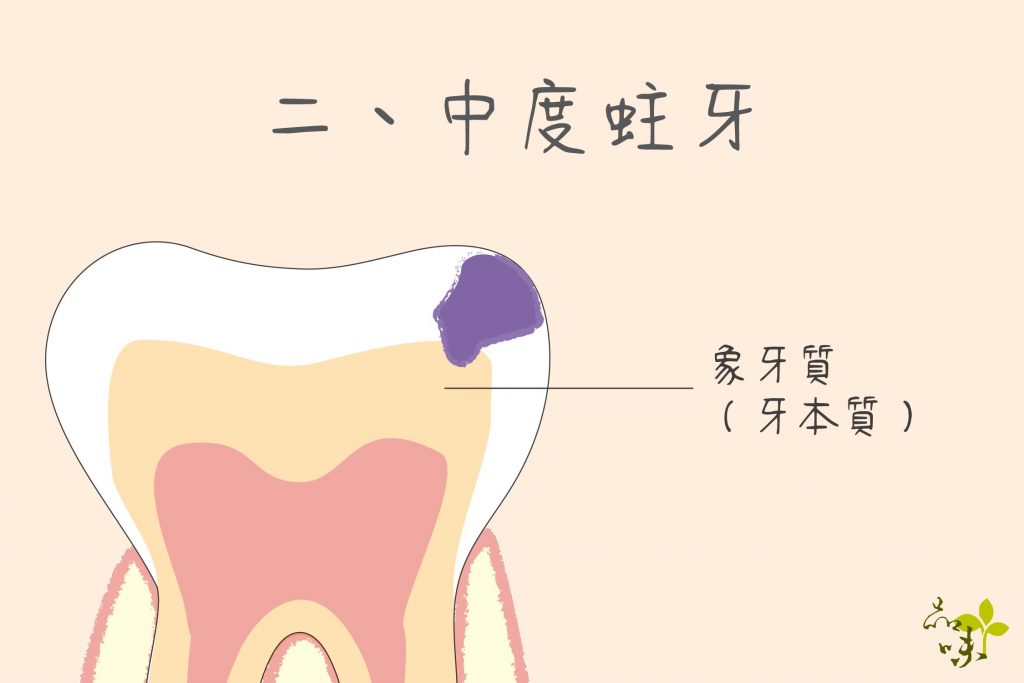 中度蛀牙有侵犯到象牙質