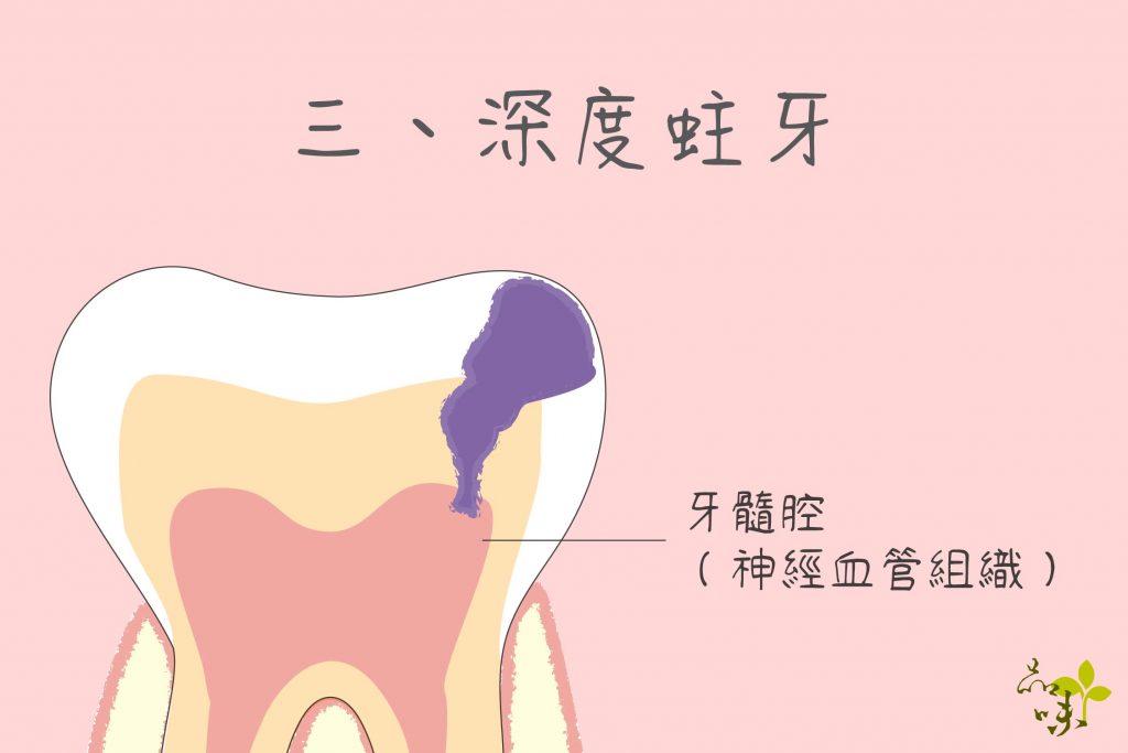 深度蛀牙有蛀到或極接近牙髓腔