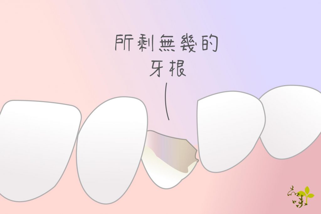 所剩無幾的牙根,還有機會用 牙冠增長術 保存下來