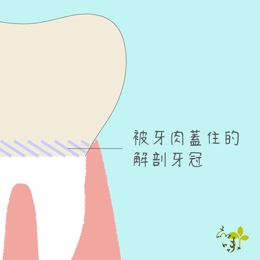 解剖牙冠被牙肉蓋住的部分