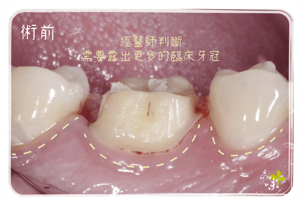牙冠增長術 術前臨床牙冠露不夠多