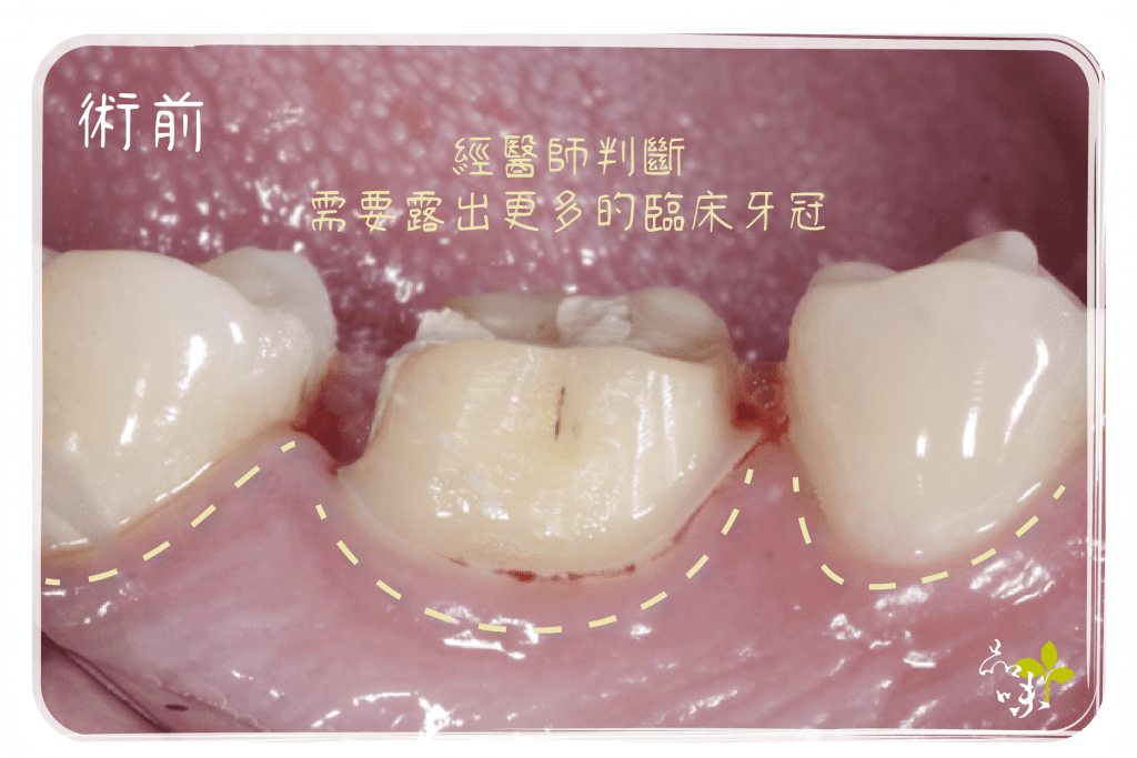  牙冠增長術 術前臨床牙冠露不夠多