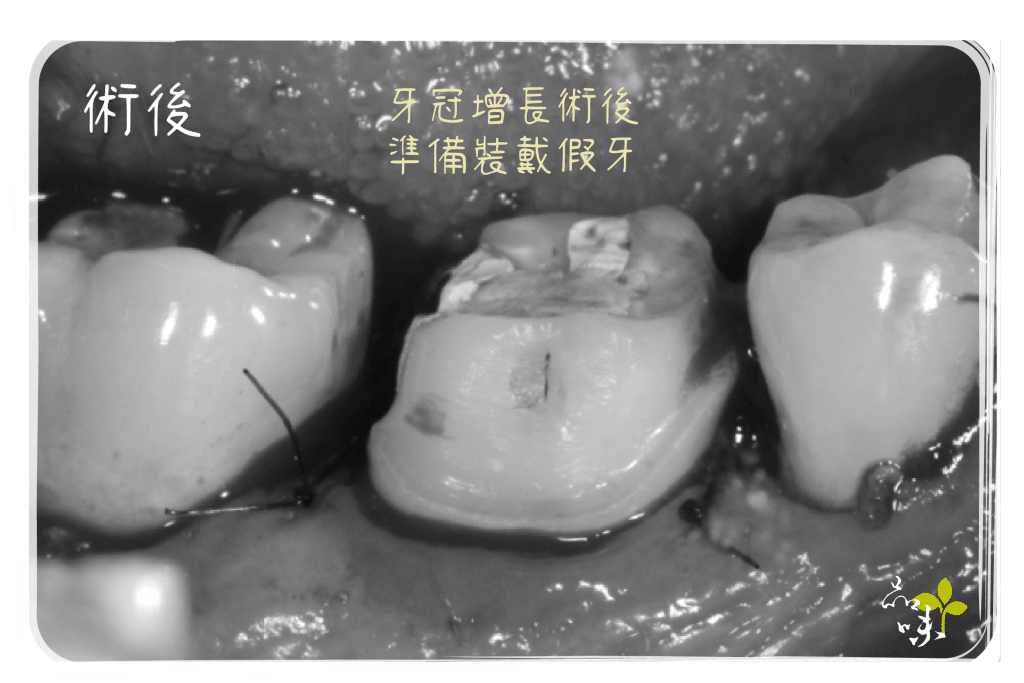 牙冠增長術 後增加了臨床牙冠的高度