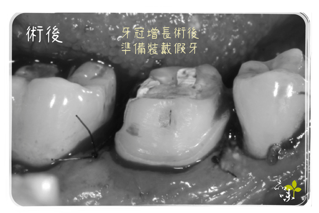  牙冠增長術 後增加了臨床牙冠的高度