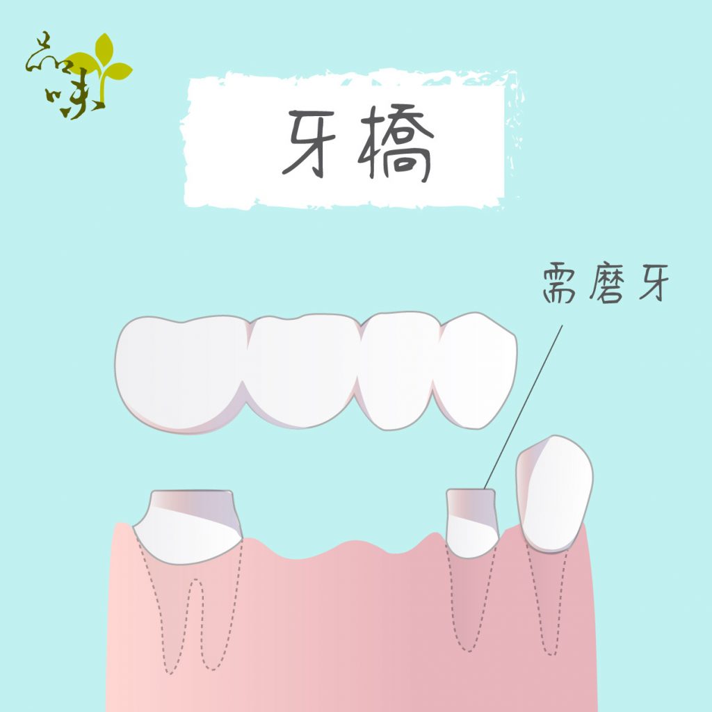 牙橋須修磨左右兩邊的牙齒，利用兩邊牙齒作為支撐，在中間搭建牙橋。