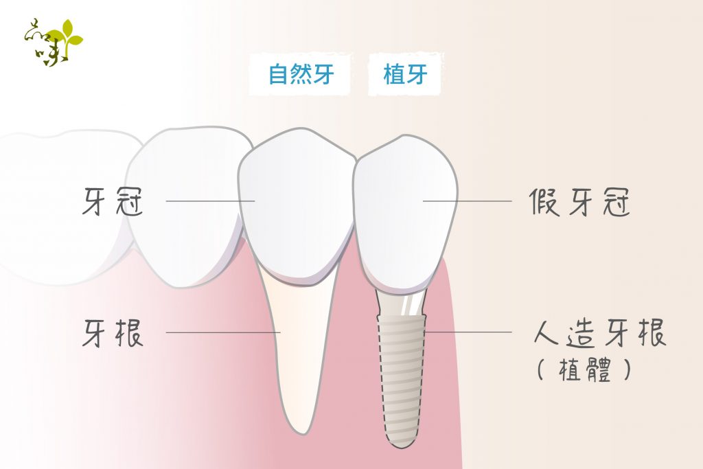 人造牙根（植體）與牙冠代替自然牙齒