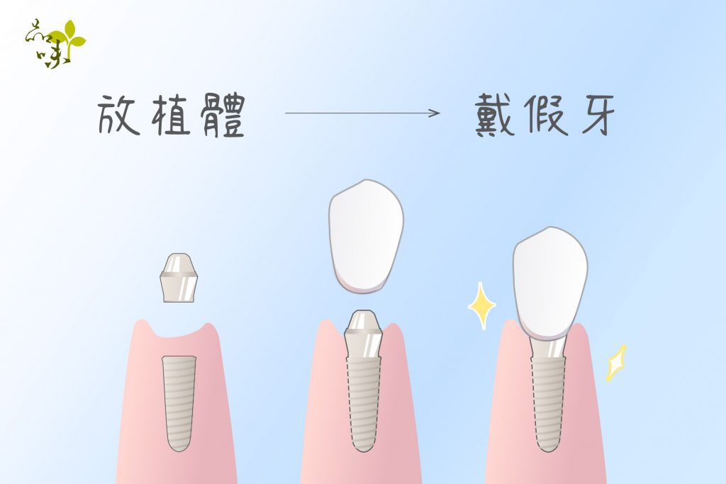 植牙手術先將顎骨修整成可放置的形狀，再放入植體，最後鎖上牙冠