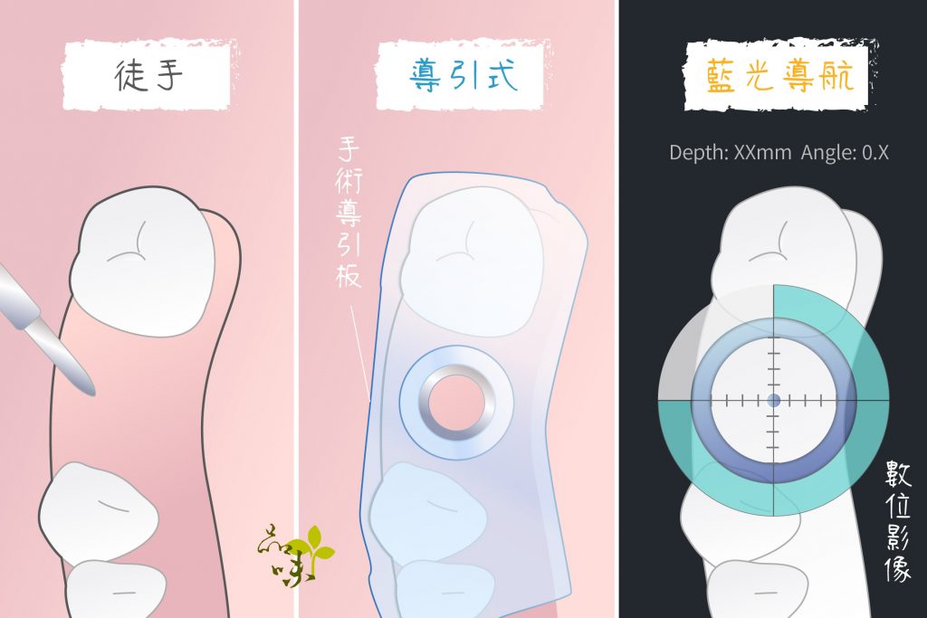 從徒手、導引式進步到藍光導航式植牙手術方式降低 植牙危險 