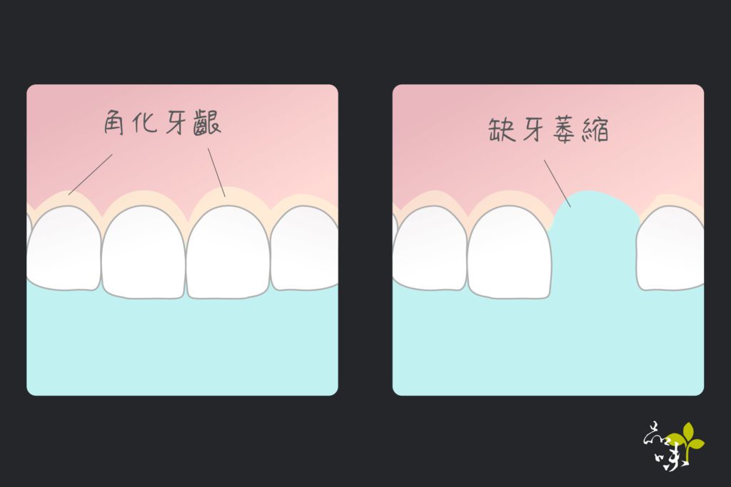 角化牙齦在缺牙後會隨時間逐漸萎縮