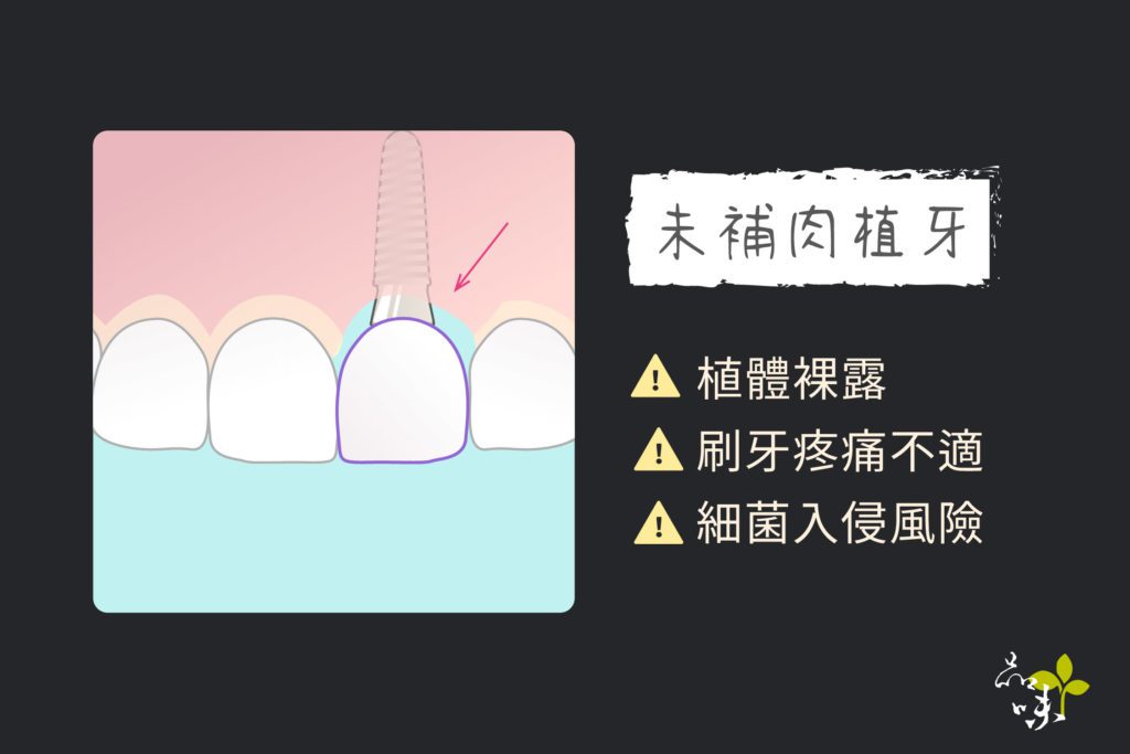 未補肉植牙可能造成：植體裸露、刷牙疼痛不適、細菌入侵風險