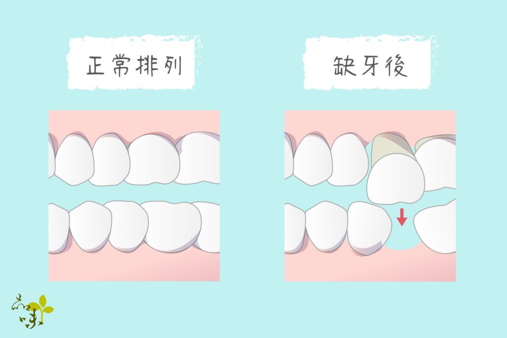 缺牙後導致對咬牙掉落