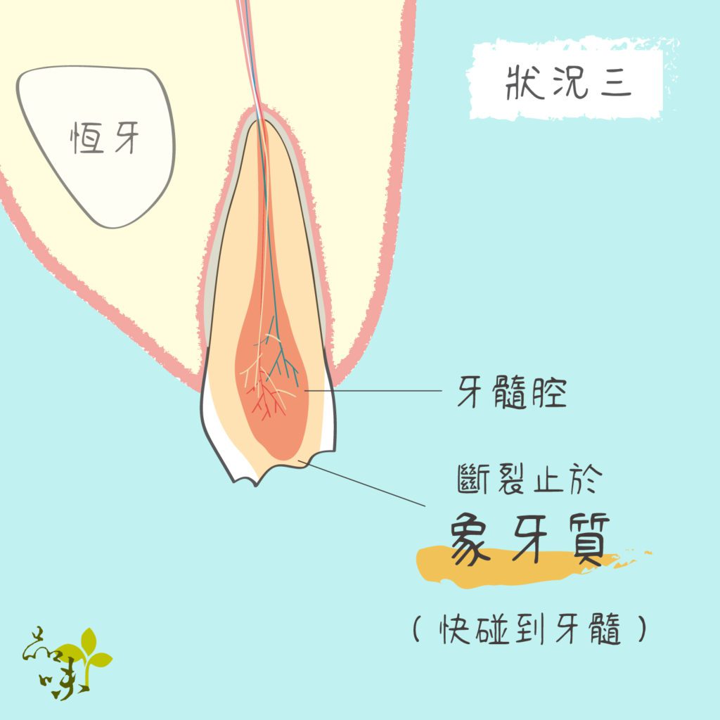 牙齒斷裂