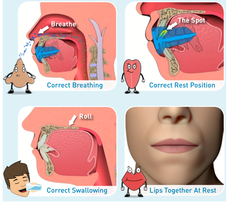 MRC功能性裝置改善 口呼吸 ，建立正確鼻呼吸習慣