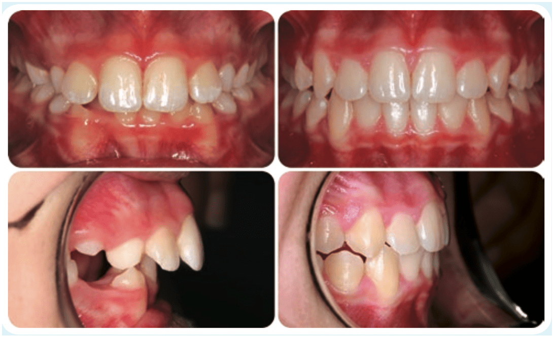 兒童牙齒矯正黃金期是何時 牙齒矯正的藝術 Dr 珊 台中隱適美隱形矯正