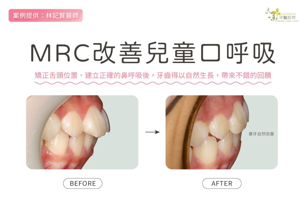 MRC改善口呼吸暴牙案例照片