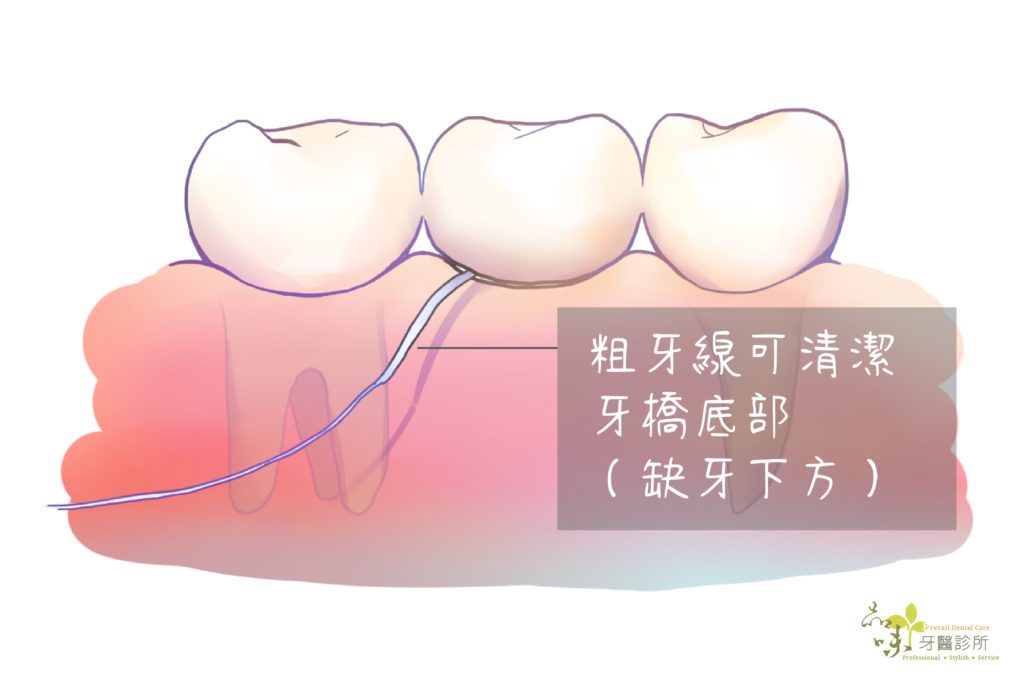 粗牙線可以清潔牙橋底部