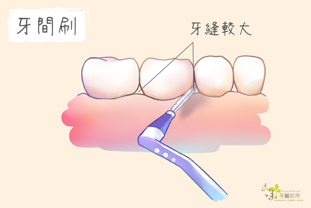 牙間刷適合牙縫較大的人