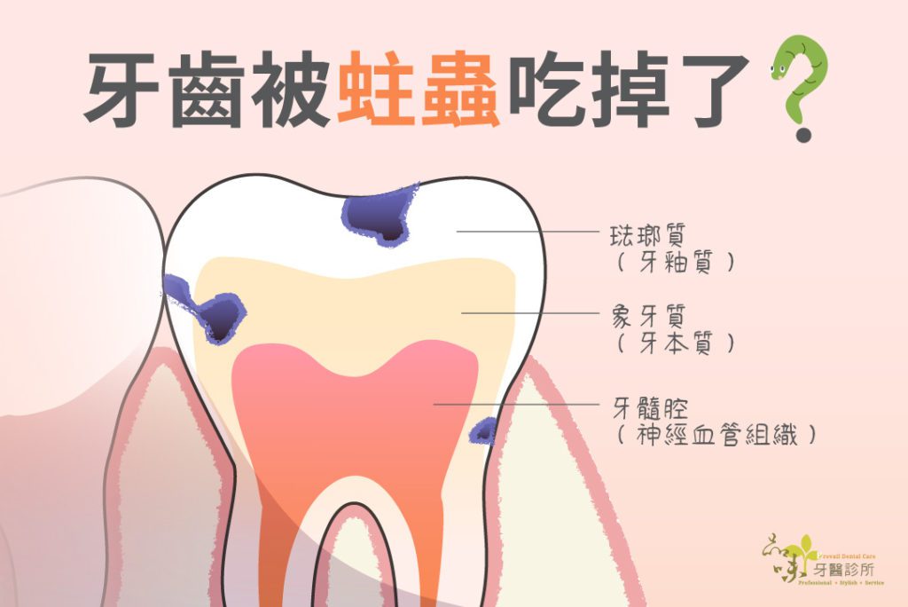 蛀牙蟲吃到珐瑯質和牙本質