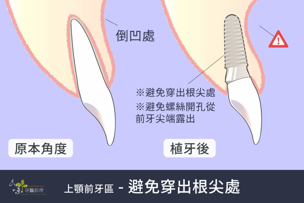 真牙和植牙的假牙在牙齦倒凹處的對比圖