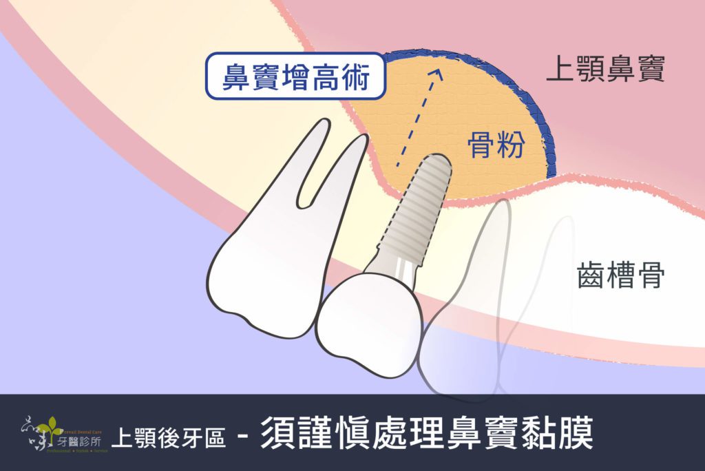 放入骨粉做鼻竇增高術的圖