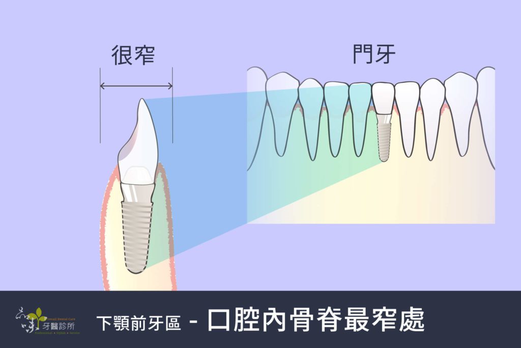 側看門牙的齒槽骨很窄