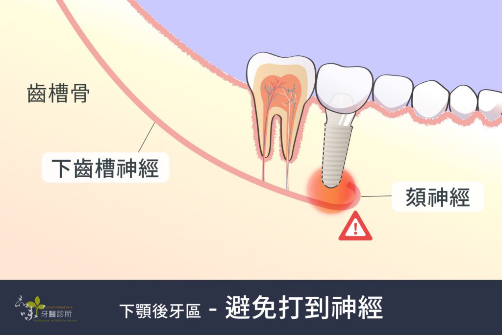 植牙的植體避免傷到齒槽骨裡的下齒槽神經和頦神經