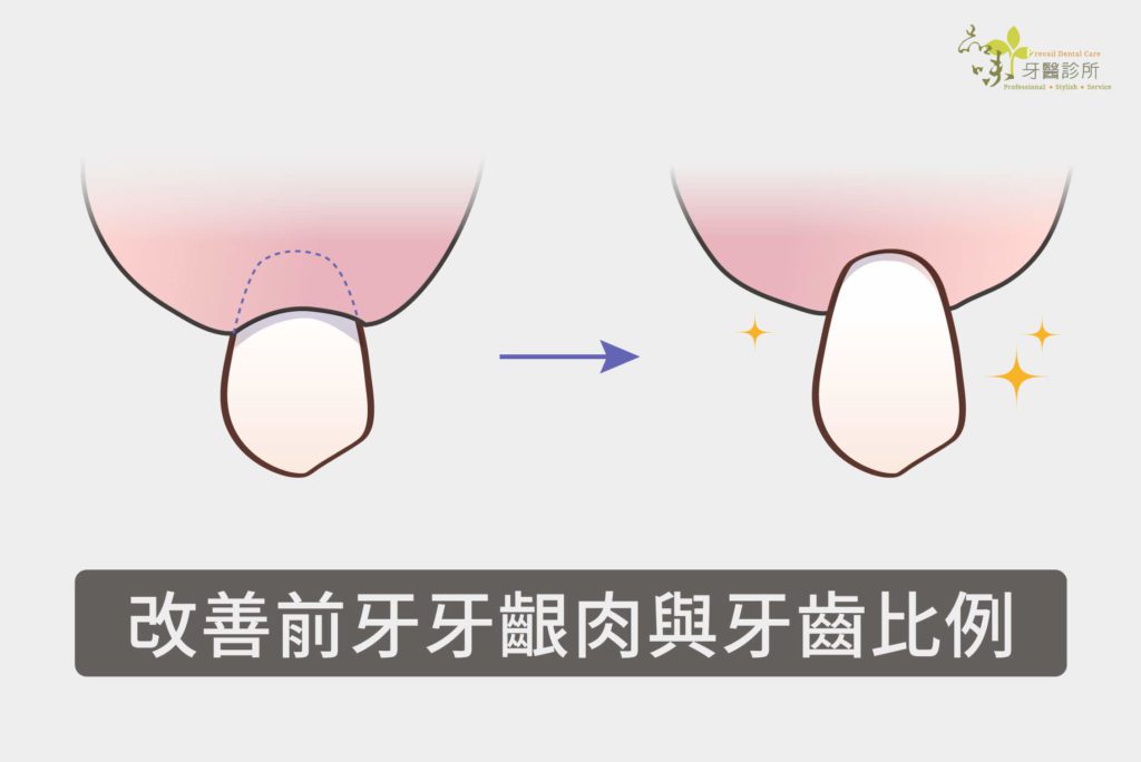 一顆前牙的牙齦網上削短