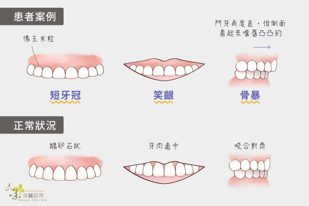 短牙冠笑齦骨暴改善後的樣子