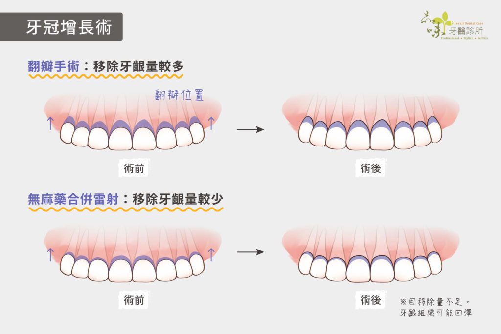 移除牙齦量較多和較少的手術圖