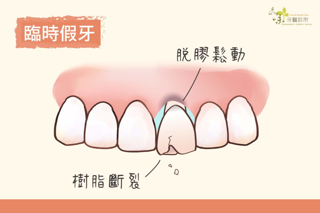 臨時假牙為樹脂材質可能會鬆脫斷裂