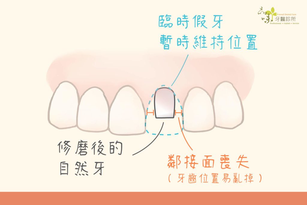 修磨後的牙齒形狀較小，無法與鄰牙相黏容易跑位