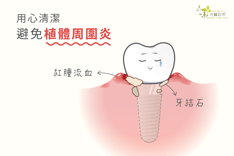 植牙後紅腫流血、牙結石堆積可能代表植體周圍炎
