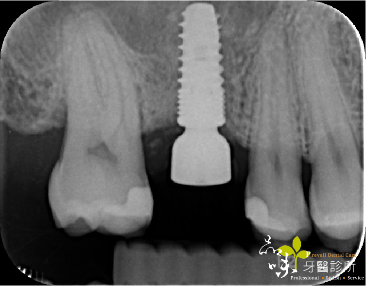植牙手術後的Ｘ光片