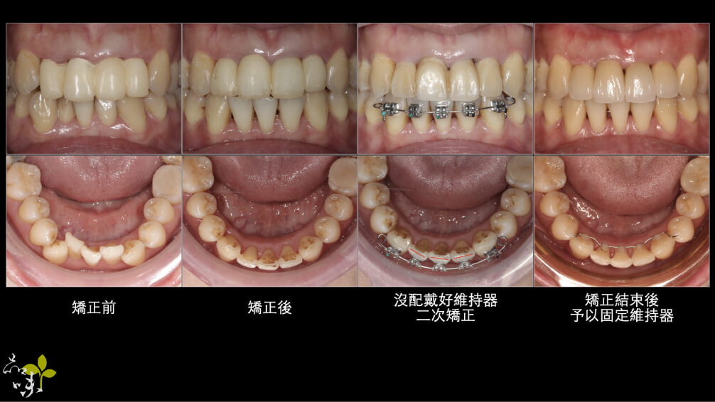 牙齒校正後隨時間變化的口腔圖片