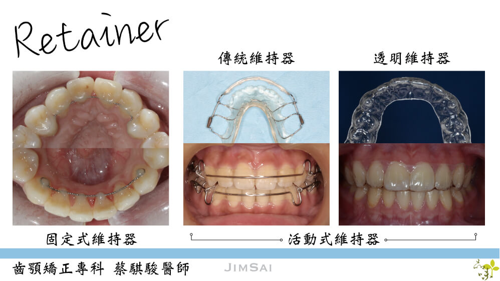 三種不同維持器戴在牙齒上的樣子