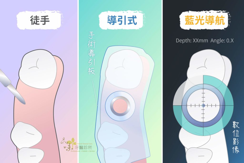 徒手 導引板 藍光導航植牙