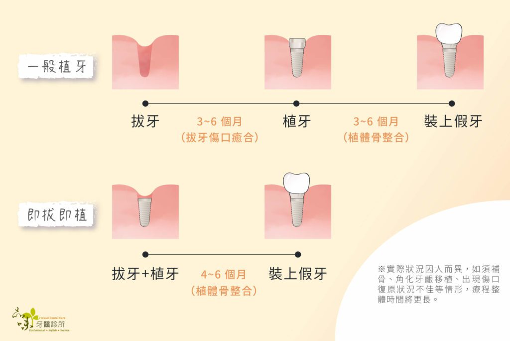 植牙與即拔即植流程時間比較