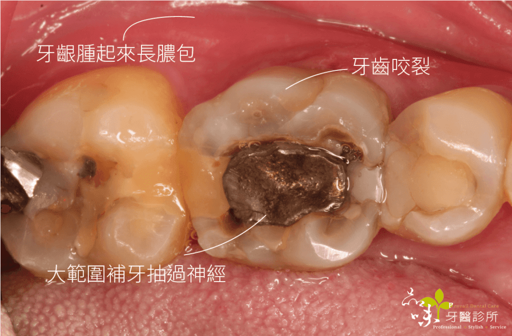 下顎臼齒牙齒裂開俯瞰圖