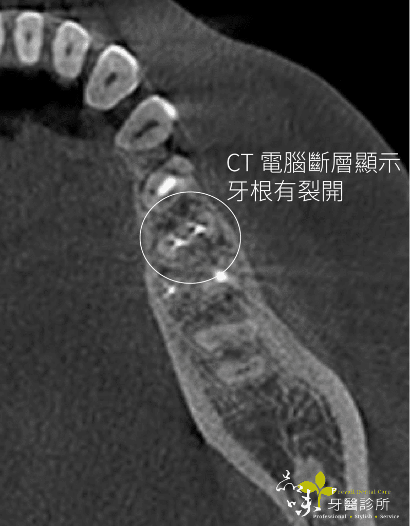 牙裂的ＣＴ電腦斷層圖片