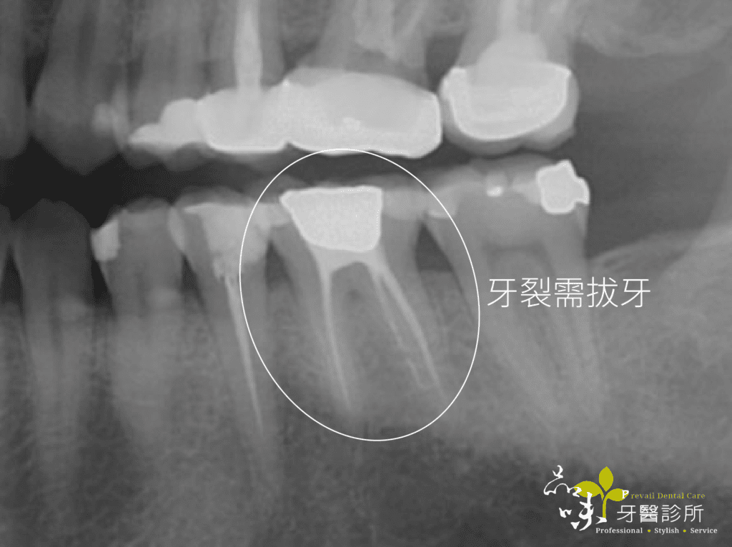 臼齒即拔即植牙術前Ｘ光