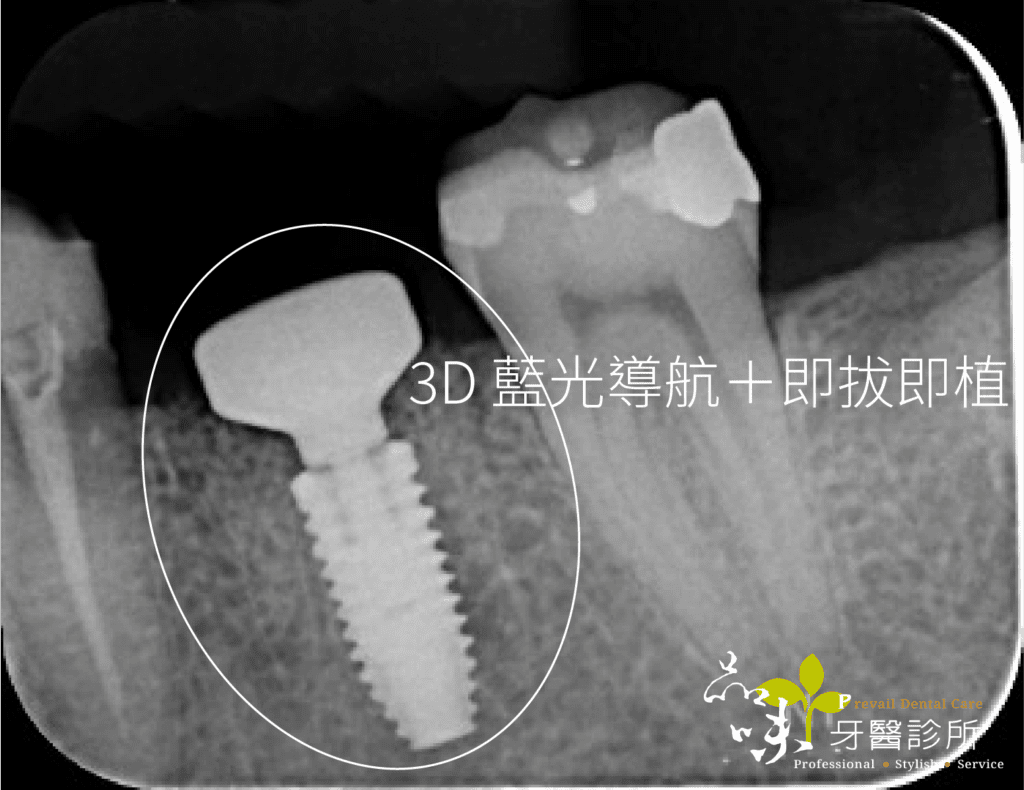 藍光導航植牙術後