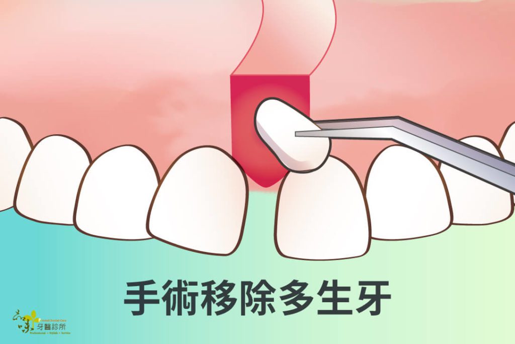 手術移除多生牙